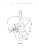 Surgical Method Utilizing Transluminal Endoscope and Instruments diagram and image