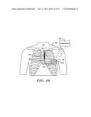 ROBUST RATE CALCULATION IN AN IMPLANTABLE CARDIAC STIMULUS OR MONITORING     DEVICE diagram and image