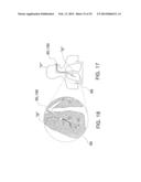 MICROWAVE ABLATION CATHETER AND METHOD OF UTILIZING THE SAME diagram and image