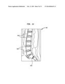 PERCUTANEOUS TRANSPEDICULAR ENDOVERTEBRAL DEVICE diagram and image