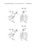 PERCUTANEOUS TRANSPEDICULAR ENDOVERTEBRAL DEVICE diagram and image