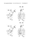 PERCUTANEOUS TRANSPEDICULAR ENDOVERTEBRAL DEVICE diagram and image