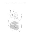 MICROWAVE ABLATION CATHETER AND METHOD OF UTILIZING THE SAME diagram and image