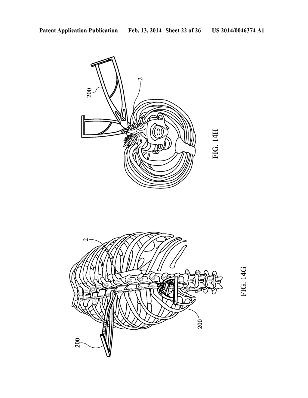 Staged Locking of Surgical Screw Assembly - diagram, schematic, and image 23