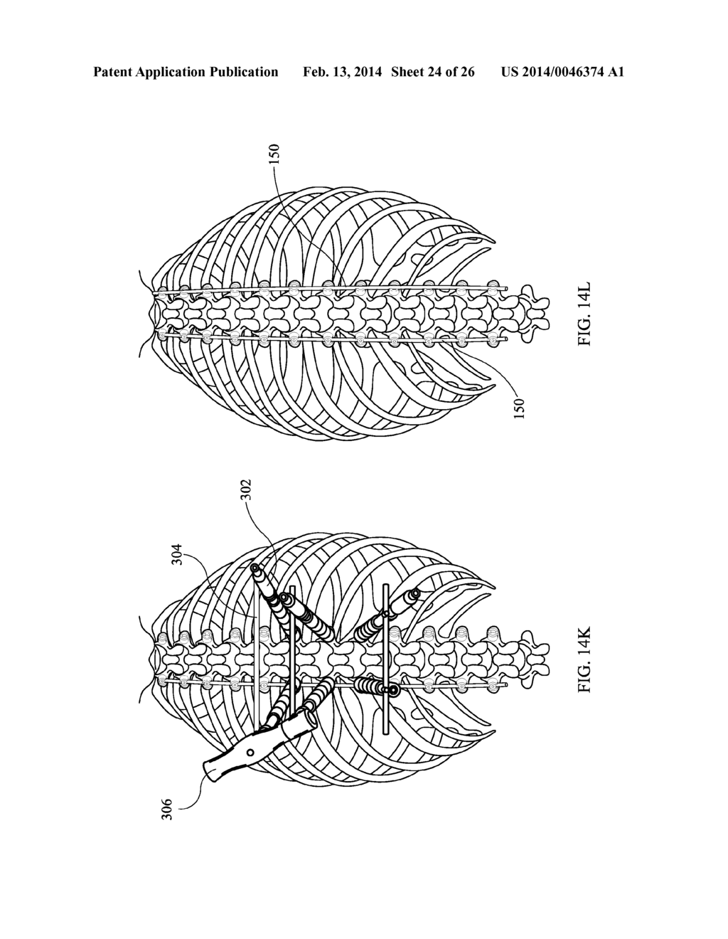 Staged Locking of Surgical Screw Assembly - diagram, schematic, and image 25