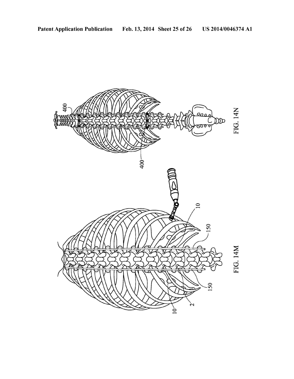 Staged Locking of Surgical Screw Assembly - diagram, schematic, and image 26