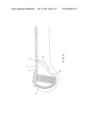 Bone Stabilization Device diagram and image