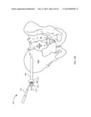 SYSTEM FOR JOINT FUSION diagram and image