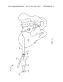 SYSTEM FOR JOINT FUSION diagram and image