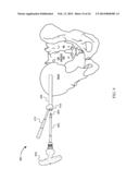 SYSTEM FOR JOINT FUSION diagram and image