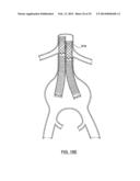 STENT DELIVERY SYSTEMS AND ASSOCIATED METHODS diagram and image