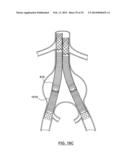 STENT DELIVERY SYSTEMS AND ASSOCIATED METHODS diagram and image