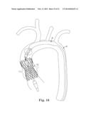 STENTED TRANSCATHETER PROSTHETIC HEART VALVE DELIVERY SYSTEM AND METHOD diagram and image