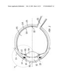 Ocular Collar Stent for Treating Narrowing of the Irideocorneal Angle diagram and image