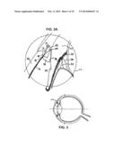 Ocular Collar Stent for Treating Narrowing of the Irideocorneal Angle diagram and image