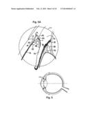 Ocular Collar Stent for Treating Narrowing of the Irideocorneal Angle diagram and image