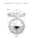 Ocular Collar Stent for Treating Narrowing of the Irideocorneal Angle diagram and image