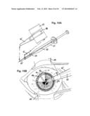 Ocular Collar Stent for Treating Narrowing of the Irideocorneal Angle diagram and image