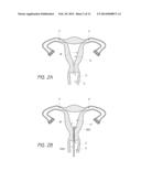 INTRAUTERINE CONTRACEPTIVE DEVICE diagram and image