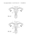 INTRAUTERINE CONTRACEPTIVE DEVICE diagram and image