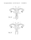 INTRAUTERINE CONTRACEPTIVE DEVICE diagram and image