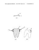 COATING FOR A DENTAL MATRIX BAND diagram and image