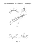 METHOD AND DEVICE FOR TREATING DYSFUNCTIONAL CARDIAC TISSUE diagram and image