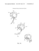 METHOD AND DEVICE FOR TREATING DYSFUNCTIONAL CARDIAC TISSUE diagram and image