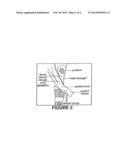 Injection Of Fibrin Sealant Including An Anesthetic In Spinal Applications diagram and image