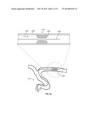 DEVICES AND SYSTEMS FOR THROMBUS TREATMENT diagram and image