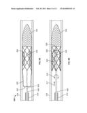 DEVICES AND SYSTEMS FOR THROMBUS TREATMENT diagram and image