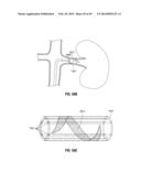 FLEXIBLE MICROWAVE CATHETERS FOR NATURAL OR ARTIFICIAL LUMENS diagram and image