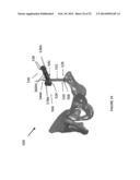 HIP REPLACEMENT NAVIGATION SYSTEM AND METHOD diagram and image