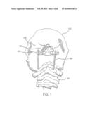 MODULAR OCCIPITAL PLATE diagram and image