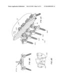 Posterior Spine Attachment Device for Hardware and Paraspinal Musculature diagram and image