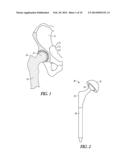 TROCHANTER ATTACHMENT DEVICE diagram and image