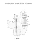 TROCHANTER ATTACHMENT DEVICE diagram and image