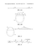 PHYSIOLOGICAL VIBRATION DETECTION IN AN IMPLANTED MEDICAL DEVICE diagram and image