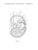 ELECTRICAL STIMULATION OF THE SYMPATHETIC NERVE CHAIN diagram and image