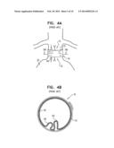REDUCED-STRAIN EXTRA- VASCULAR RING FOR TREATING AORTIC ANEURYSM diagram and image