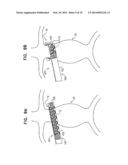 REDUCED-STRAIN EXTRA- VASCULAR RING FOR TREATING AORTIC ANEURYSM diagram and image