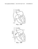 DEVICES AND METHODS FOR DELIVERY OF VALVE PROSTHESES diagram and image