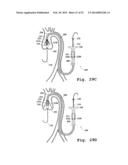 DEVICES AND METHODS FOR DELIVERY OF VALVE PROSTHESES diagram and image