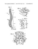 Crossbar Spinal Prosthesis Having a Modular Design and Related     Implantation Methods diagram and image
