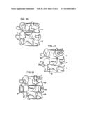 Crossbar Spinal Prosthesis Having a Modular Design and Related     Implantation Methods diagram and image