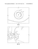 PROTECTIVE DEVICE FOR IMPLANTED MEDICAL DEVICE diagram and image