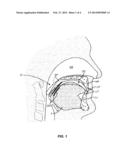 ORAL DEVICE FOR ANTERIOR ADVANCEMENT AND MEDIAL CONSTRAINT OF THE TONGUE diagram and image