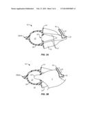 ORAL DEVICE FOR ANTERIOR ADVANCEMENT AND MEDIAL CONSTRAINT OF THE TONGUE diagram and image