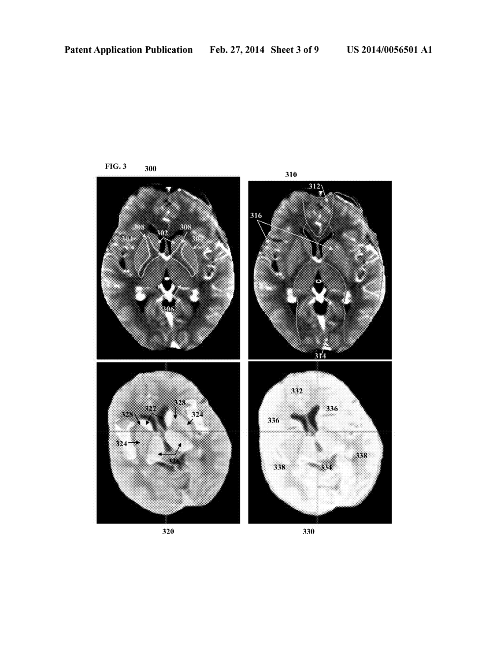 Method and System for Multi-Atlas Segmentation of Brain Computed     Tomography Image Data - diagram, schematic, and image 04