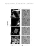 LARGE ONCOSOMES IN HUMAN TUMORS AND IN CIRCULATION IN PATIENTS WITH CANCER diagram and image